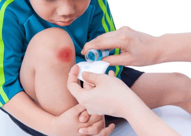 Cara Merawat Luka Ringan: 3 Prinsip Dasar dari Ahli agar Cepat Sembuh