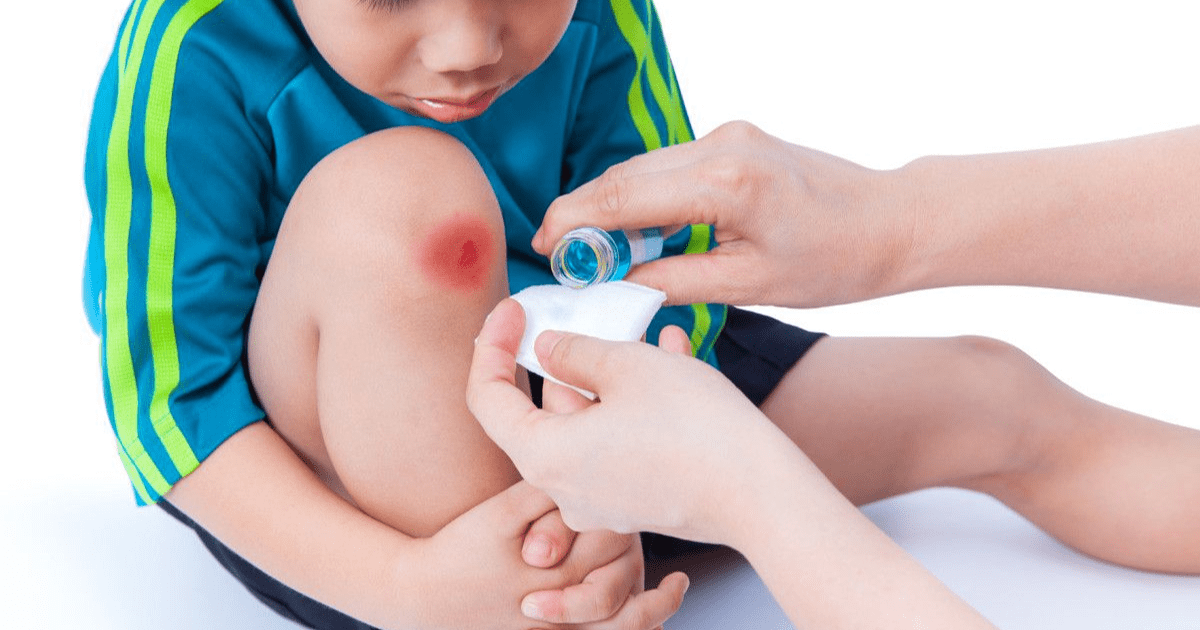 Cara Merawat Luka Ringan: 3 Prinsip Dasar dari Ahli agar Cepat Sembuh